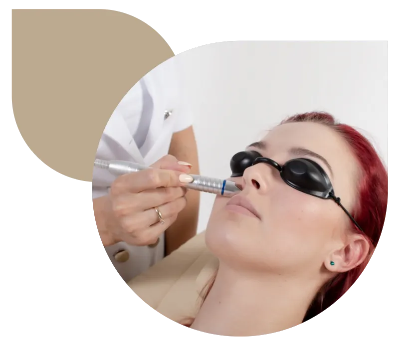 Laserowe usuwanie naczynek