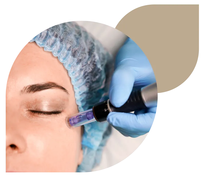 Mezoterapia Mikroigłowa - DERMAPEN